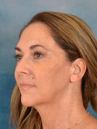 Deep Plane Facelift Before & After Gallery - Patient 285923 - Image 1