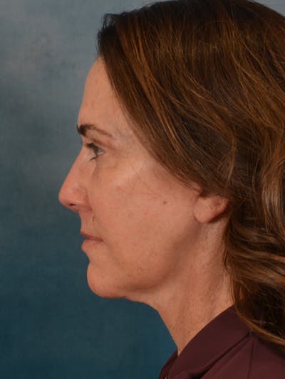 Laser Skin Resurfacing Before & After Gallery - Patient 303991 - Image 10
