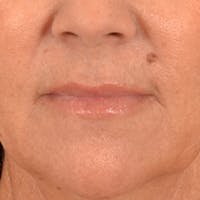 Lip Lift Before & After Gallery - Patient 292357 - Image 1