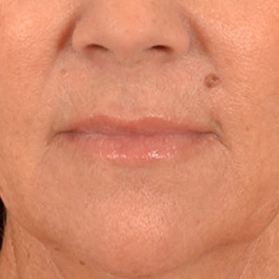 Lip Lift Before & After Gallery - Patient 292357 - Image 1