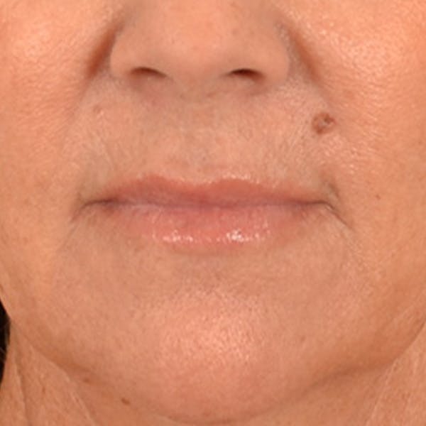 Lip Lift Before & After Gallery - Patient 292357 - Image 1