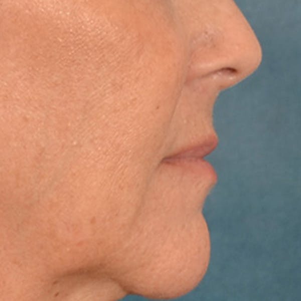 Lip Lift Before & After Gallery - Patient 292357 - Image 5