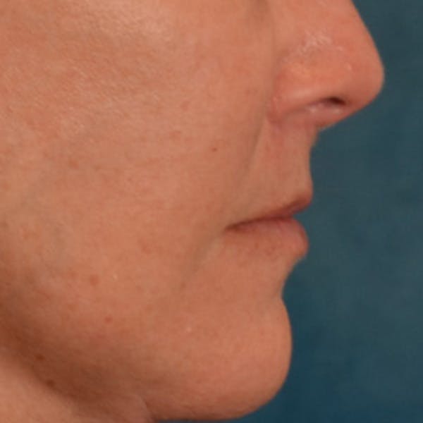 Lip Lift Before & After Gallery - Patient 292357 - Image 6