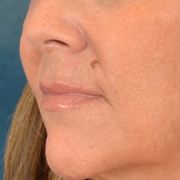 Lip Lift Before & After Gallery - Patient 292357 - Image 7