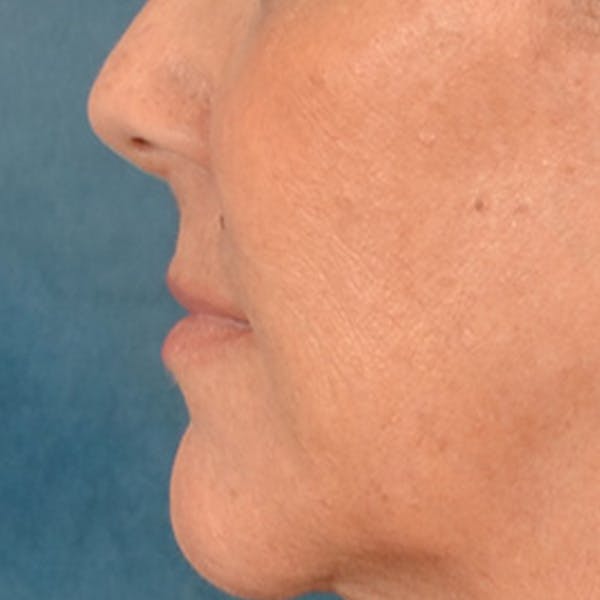 Lip Lift Before & After Gallery - Patient 292357 - Image 9