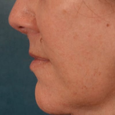 Lip Lift Before & After Gallery - Patient 292357 - Image 10