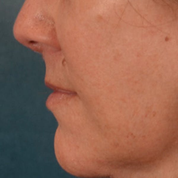 Lip Lift Before & After Gallery - Patient 292357 - Image 10