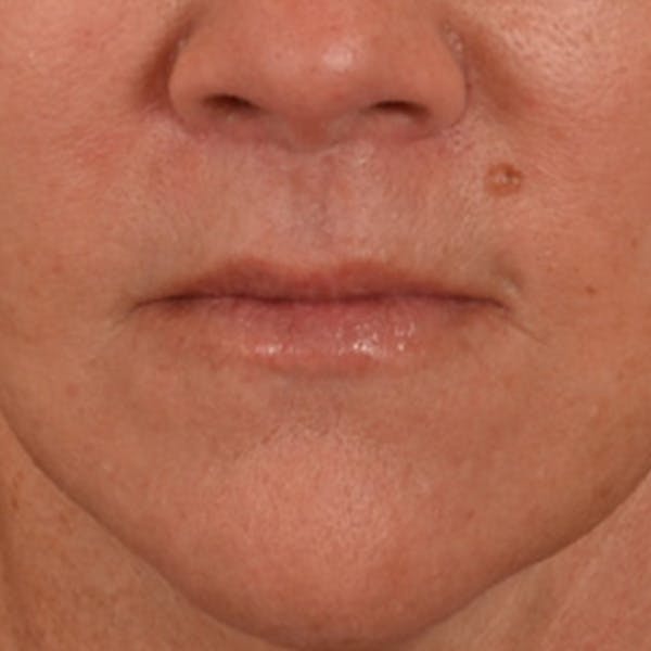 Lip Lift Before & After Gallery - Patient 292357 - Image 2