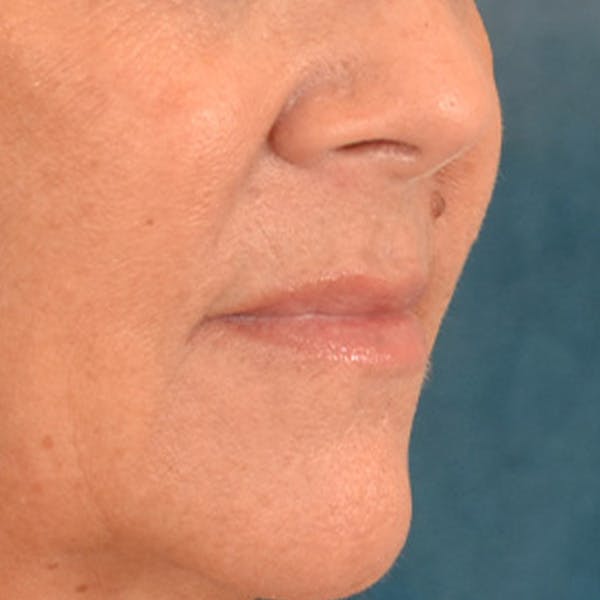Lip Lift Before & After Gallery - Patient 292357 - Image 3