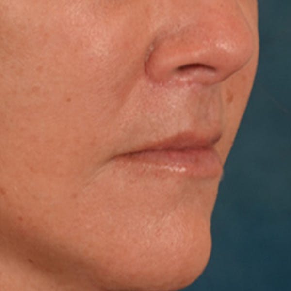 Lip Lift Before & After Gallery - Patient 292357 - Image 4