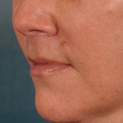 Lip Lift Before & After Gallery - Patient 292357 - Image 8