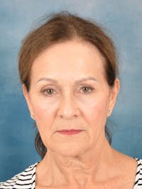 Laser Skin Resurfacing Before & After Gallery - Patient 642617 - Image 1