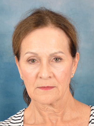 Laser Skin Resurfacing Before & After Gallery - Patient 642617 - Image 1