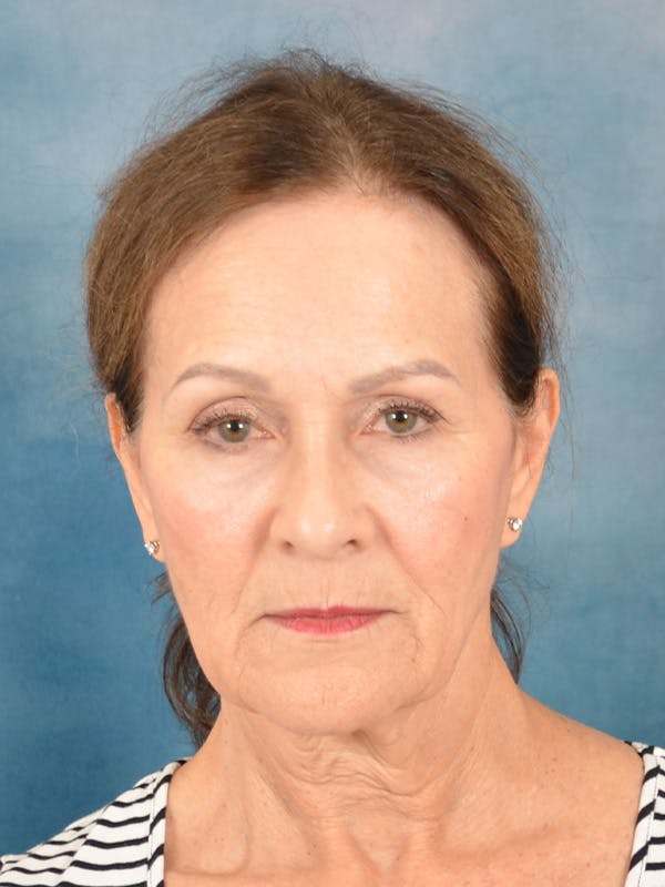 Laser Skin Resurfacing Before & After Gallery - Patient 642617 - Image 1