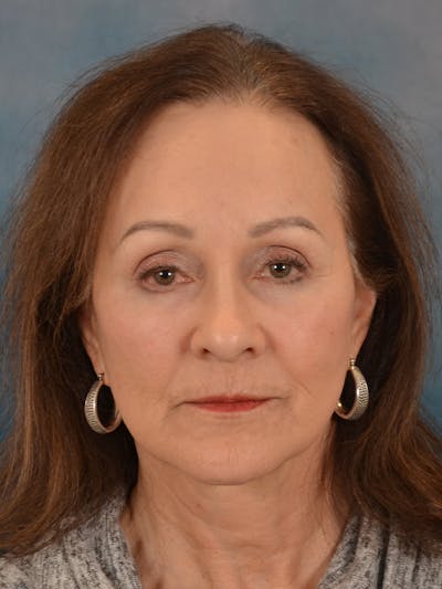 Laser Skin Resurfacing Before & After Gallery - Patient 642617 - Image 2