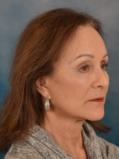 Laser Skin Resurfacing Before & After Gallery - Patient 642617 - Image 6
