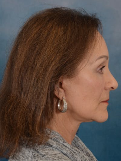 Laser Skin Resurfacing Before & After Gallery - Patient 642617 - Image 10