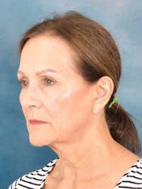 Brow Lift Before & After Gallery - Patient 153863 - Image 1