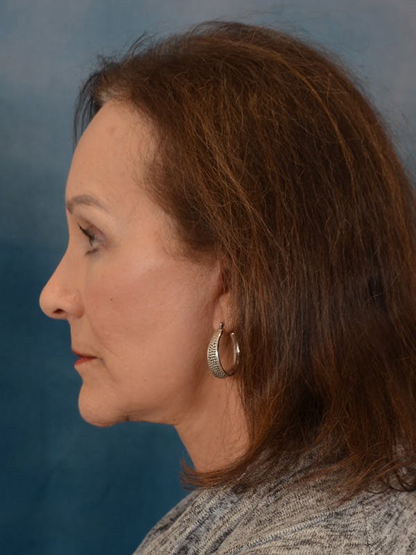 Laser Skin Resurfacing Before & After Gallery - Patient 642617 - Image 8