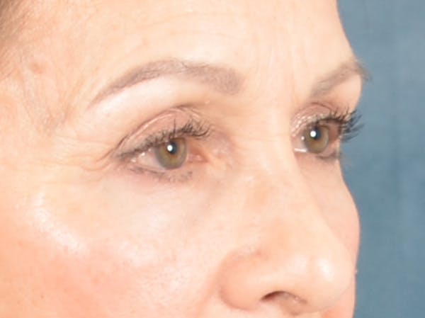 Eyelid Lift Before & After Gallery - Patient 298635 - Image 3