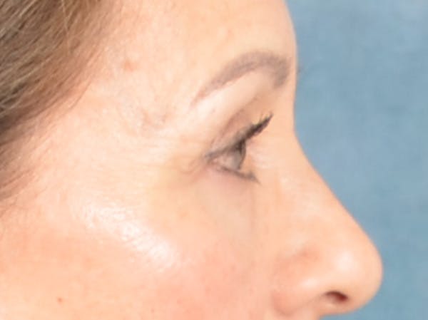 Eyelid Lift Before & After Gallery - Patient 298635 - Image 5
