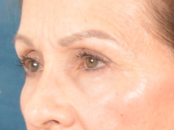 Eyelid Lift Before & After Gallery - Patient 298635 - Image 7