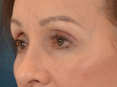 Eyelid Lift Before & After Gallery - Patient 298635 - Image 8