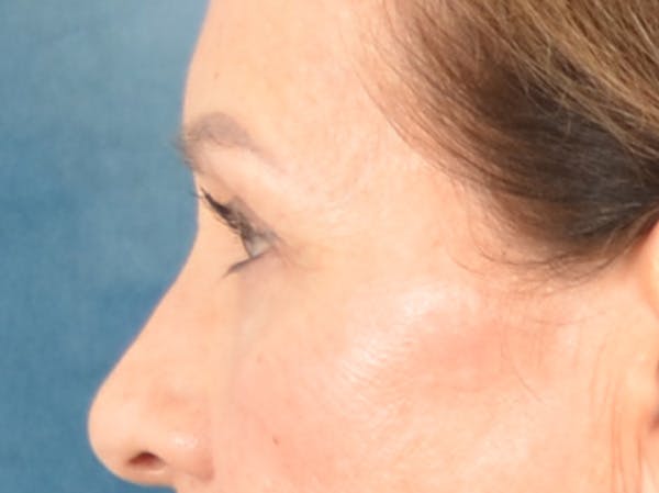 Eyelid Lift Before & After Gallery - Patient 298635 - Image 9
