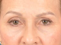 Eyelid Lift Before & After Gallery - Patient 298635 - Image 1