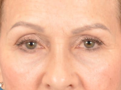 Eyelid Lift Before & After Gallery - Patient 298635 - Image 1