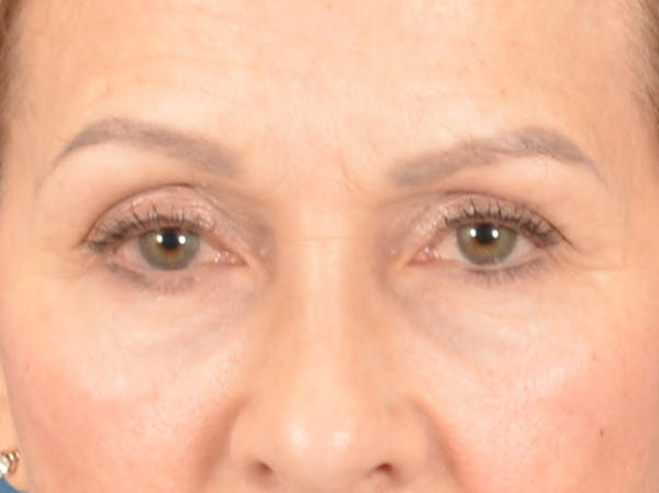 Eyelid Lift Before & After Gallery - Patient 298635 - Image 1