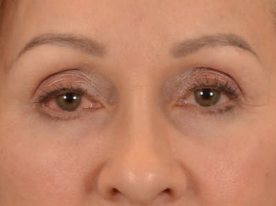 Eyelid Lift Before & After Gallery - Patient 298635 - Image 2