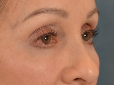 Eyelid Lift Before & After Gallery - Patient 298635 - Image 4