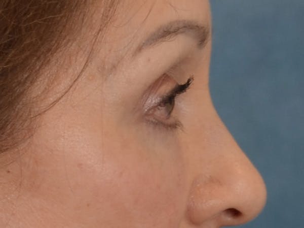 Eyelid Lift Before & After Gallery - Patient 298635 - Image 6
