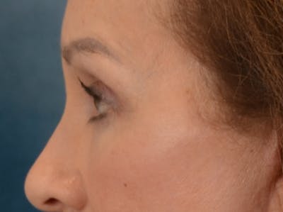 Eyelid Lift Before & After Gallery - Patient 298635 - Image 10