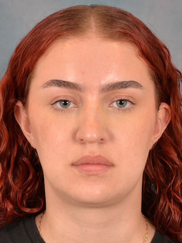 Rhinoplasty Before & After Gallery - Patient 180555 - Image 5