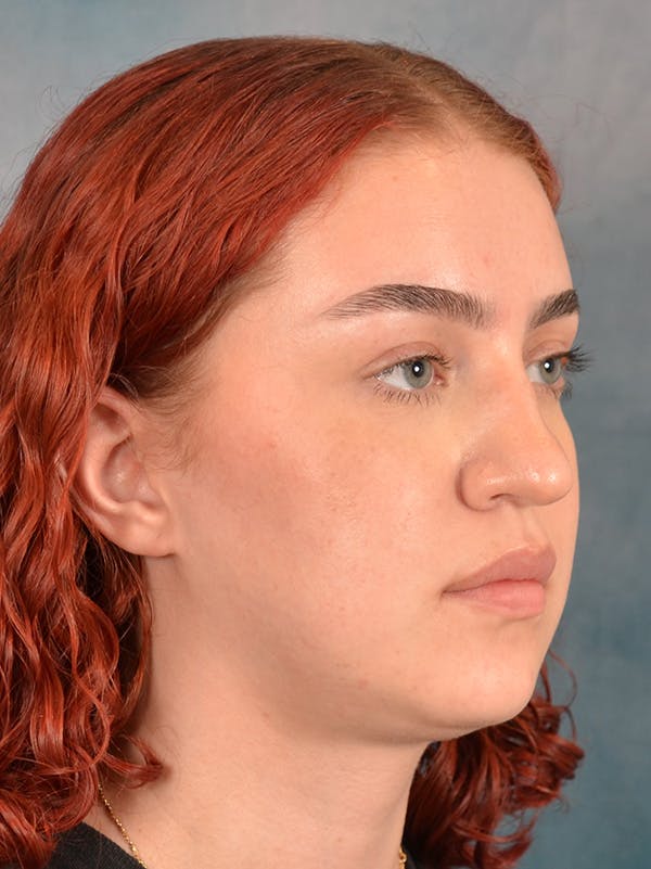 Rhinoplasty Before & After Gallery - Patient 180555 - Image 7
