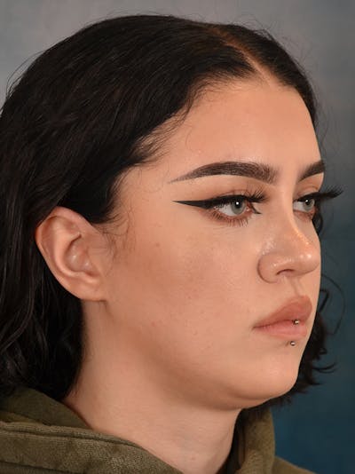 Rhinoplasty Before & After Gallery - Patient 180555 - Image 8