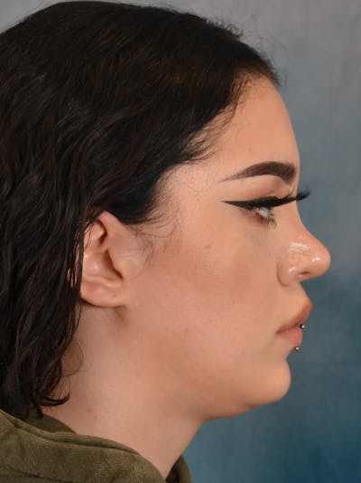 Rhinoplasty Before & After Gallery - Patient 180555 - Image 10