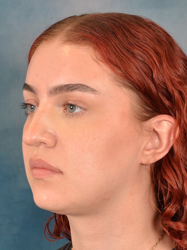 Rhinoplasty Before & After Gallery - Patient 180555 - Image 3