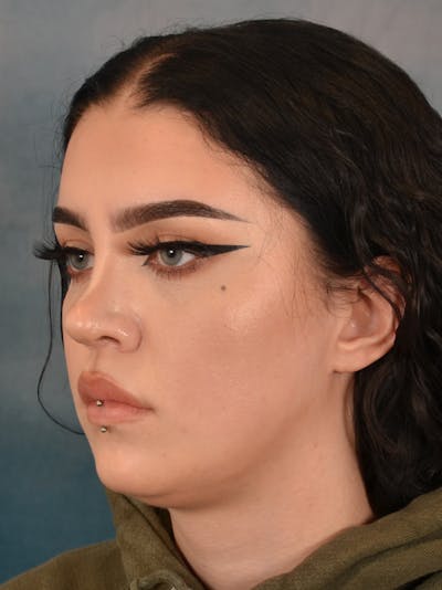 Rhinoplasty Before & After Gallery - Patient 180555 - Image 4