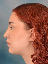 Rhinoplasty Before & After Gallery - Patient 180555 - Image 1