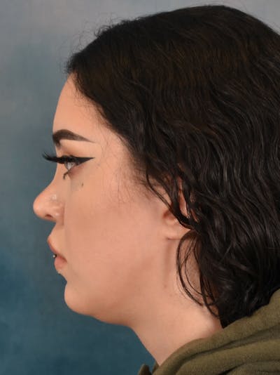 Rhinoplasty Before & After Gallery - Patient 180555 - Image 2