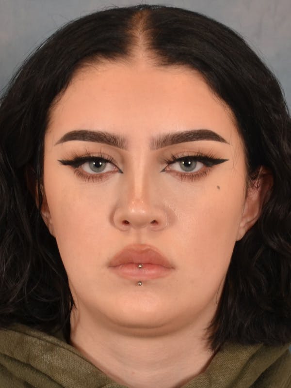 Rhinoplasty Before & After Gallery - Patient 180555 - Image 6