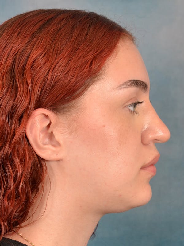 Rhinoplasty Before & After Gallery - Patient 180555 - Image 9
