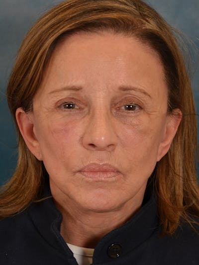Laser Skin Resurfacing Before & After Gallery - Patient 104537 - Image 2