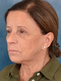 Deep Plane Facelift Before & After Gallery - Patient 628706 - Image 1