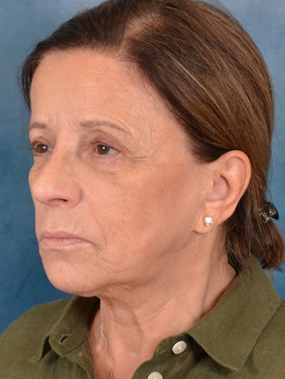 Earlobe Repair Before & After Gallery - Patient 305530 - Image 1