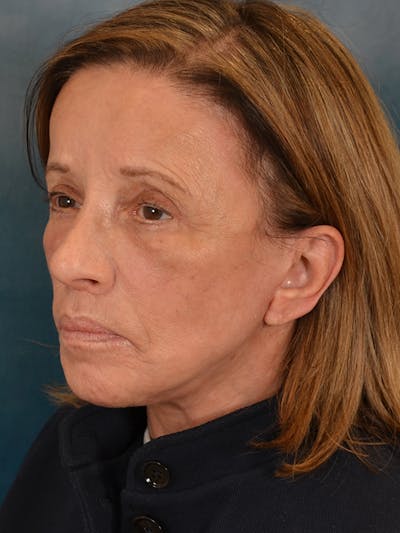 Laser Skin Resurfacing Before & After Gallery - Patient 104537 - Image 4