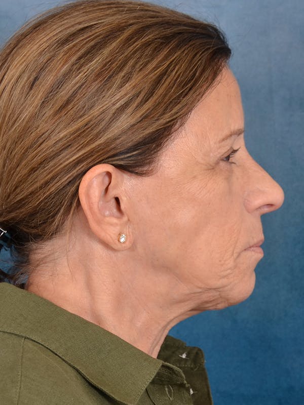 Laser Skin Resurfacing Before & After Gallery - Patient 104537 - Image 7